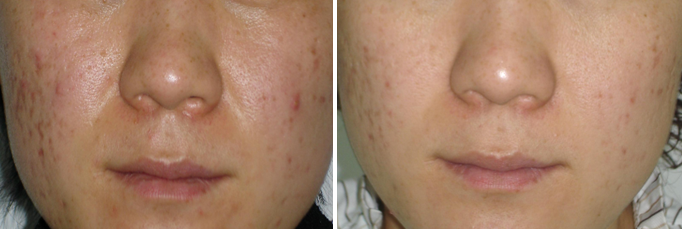 点阵激光后冷敷怎么敷非剥脱点阵激光：让你“一键”磨皮，悄然变美【美肤治肤】_https://www.jmylbn.com_新闻资讯_第11张