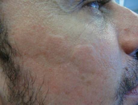 点阵激光后冷敷怎么敷非剥脱点阵激光：让你“一键”磨皮，悄然变美【美肤治肤】_https://www.jmylbn.com_新闻资讯_第15张