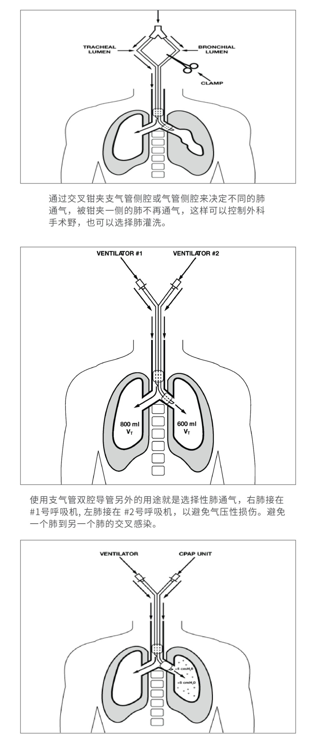 气管插管的管是什么气管插管那些事，一文帮你搞定_https://www.jmylbn.com_新闻资讯_第23张
