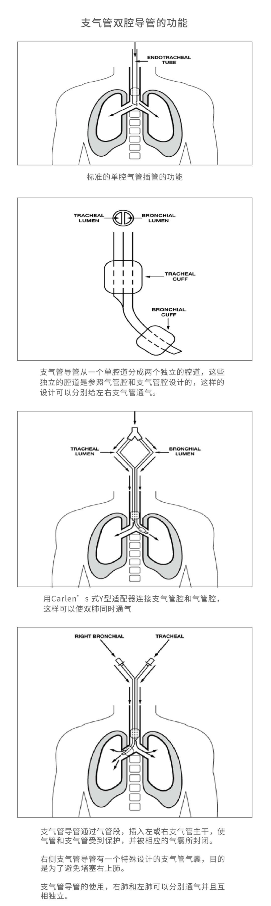 气管插管的管是什么气管插管那些事，一文帮你搞定_https://www.jmylbn.com_新闻资讯_第22张
