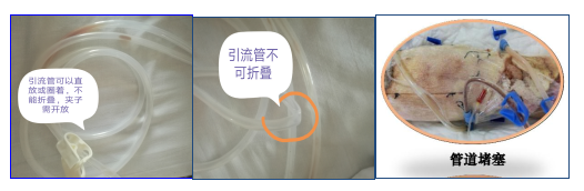 为什么负压引流健康教育系列《外科篇》22——负压封闭引流术_https://www.jmylbn.com_新闻资讯_第5张