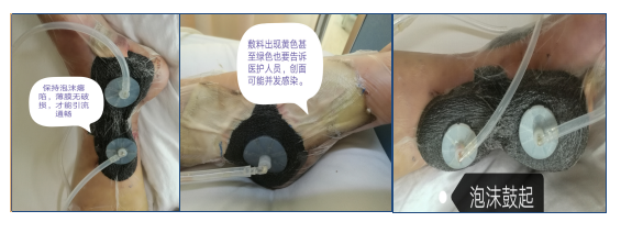 为什么负压引流健康教育系列《外科篇》22——负压封闭引流术_https://www.jmylbn.com_新闻资讯_第6张