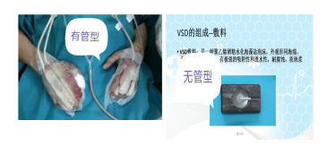 为什么负压引流健康教育系列《外科篇》22——负压封闭引流术_https://www.jmylbn.com_新闻资讯_第3张