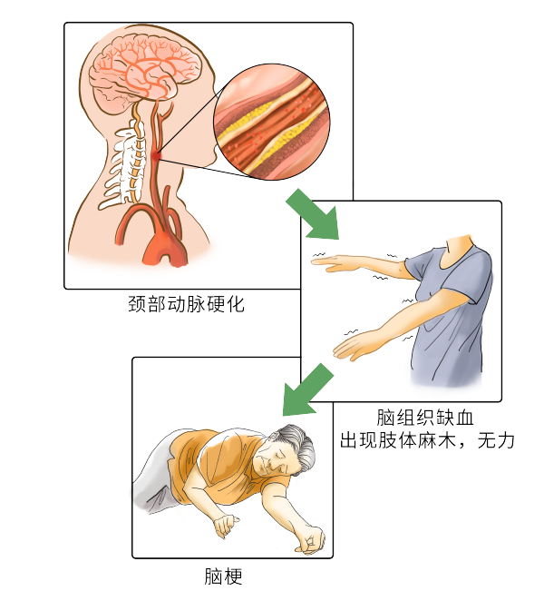 1.27脑梗 动脉粥样硬化.png