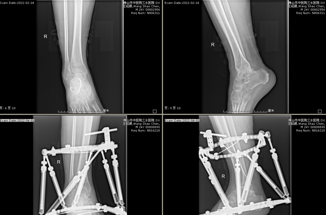 涂泽松主任开展并顺利完成右侧踝关节僵硬并畸形矫形术+跟腱延长+支架外固定术