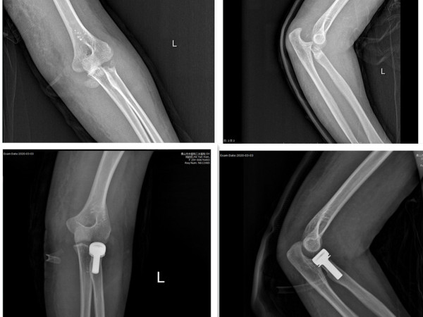 我院在李伟强主任主持下独立完成桡骨头置换术(术前及术后)