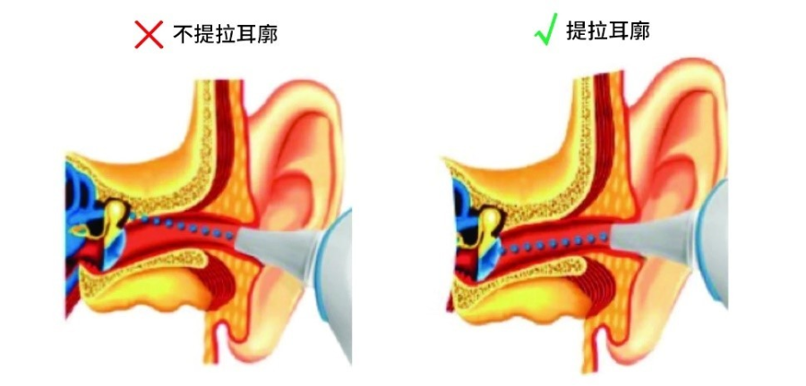 耳朵温度计怎么用额温计 or 耳温计，哪个测得准？多少度算发烧？_https://www.jmylbn.com_新闻资讯_第3张