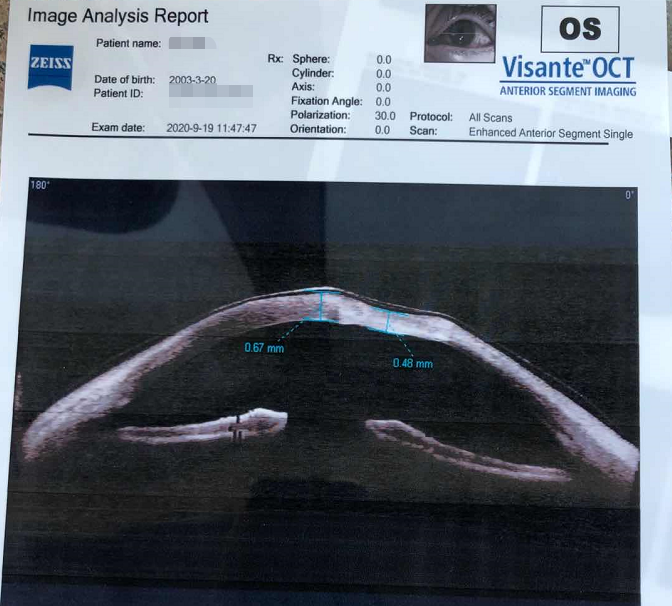 怎么判断是螨虫咬的包_被子里的螨虫咬人吗_螨虫咬人后症状图片