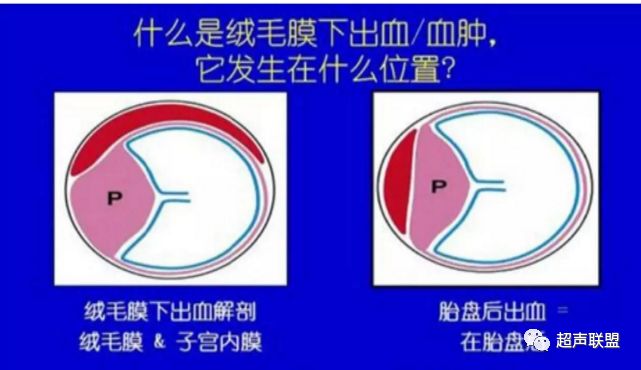 绒毛膜下血肿 超声联盟 微信公众号文章阅读 Wemp