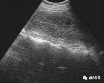 转发肾脏挫裂伤超声