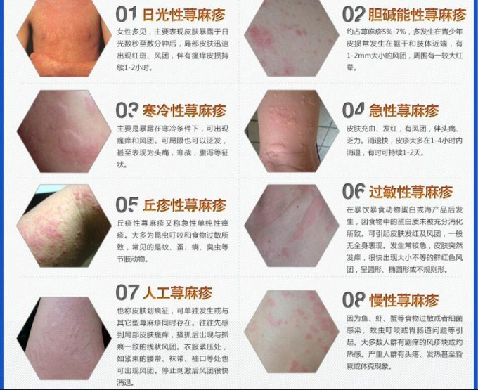 荨麻疹症状图片大全“荨麻疹真实照片”及导致荨麻疹原因