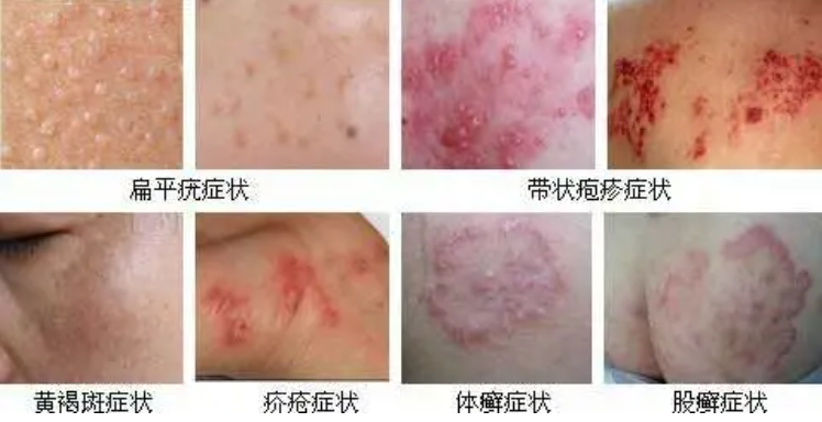 微信识别皮肤病相片皮肤病在线识别