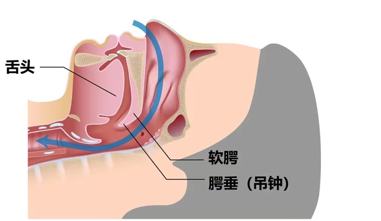 对不起，打呼噜基本没救了