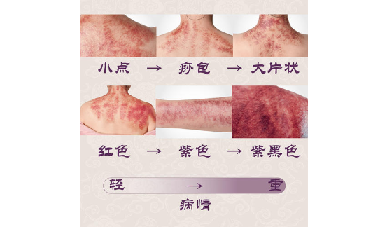 古法经络|从痧症状态看健康....看痧印识病体！