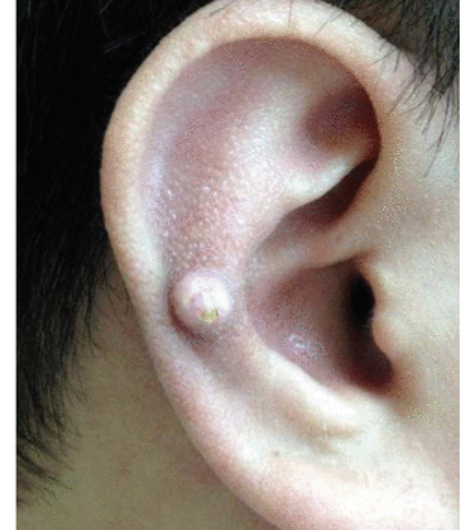 痛风石常发生于双足第一跖趾关节或双手第一掌指关节旁.