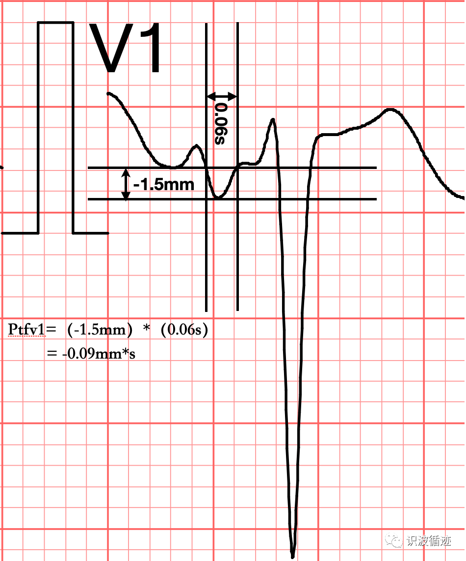 心电图mm单位怎么读心电基础：Ptfv1_https://www.jmylbn.com_新闻资讯_第3张