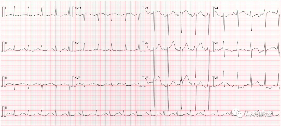 心电图mm单位怎么读心电基础：Ptfv1_https://www.jmylbn.com_新闻资讯_第2张