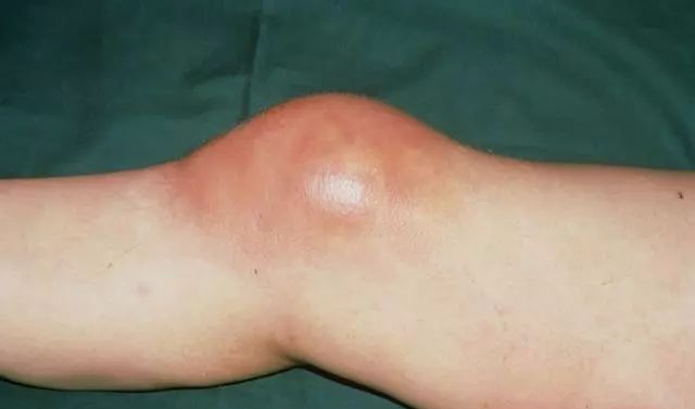 古法经络|什么是滑膜炎，平时如何保养呢？