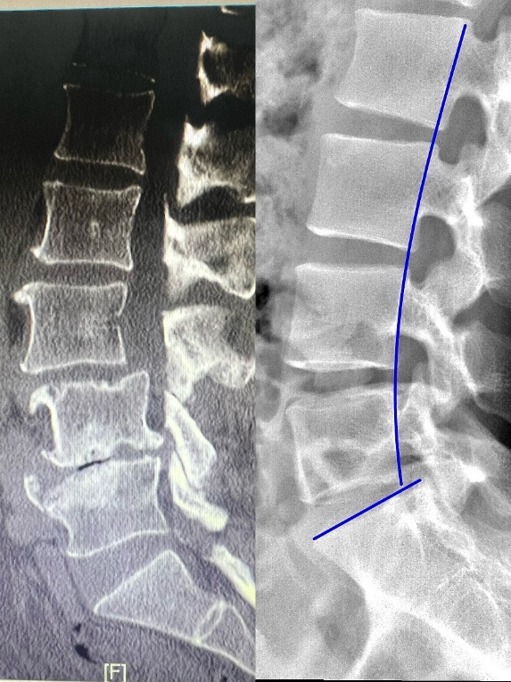 医讯怎么用【旗山医讯】人民的“医”靠 ｜ 巧用“神器”精准治疗，骨科团队连续啃下多块“硬骨头”_https://www.jmylbn.com_新闻资讯_第7张