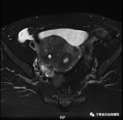 联影磁共振怎么样县妇保院引进联影1.5T超导高端磁共振_https://www.jmylbn.com_新闻资讯_第13张