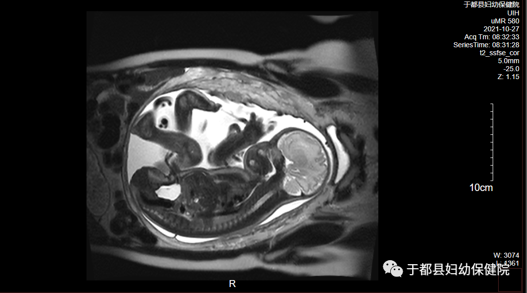 联影磁共振怎么样县妇保院引进联影1.5T超导高端磁共振_https://www.jmylbn.com_新闻资讯_第9张