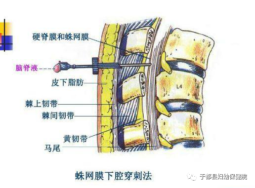 g穿刺怎么玩【新技术】25G腰麻穿刺细针进行单次腰麻在各类手术中的应用_https://www.jmylbn.com_新闻资讯_第7张