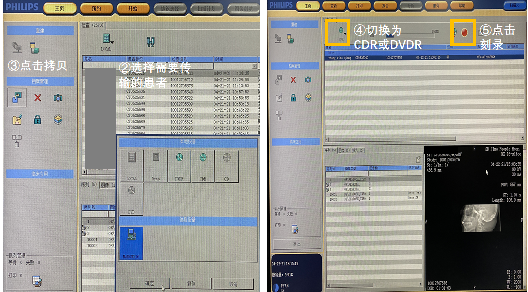 飞利浦ct有哪些型号飞利浦Access16&Mx16排CT常用操作（患者信息修改，图像离线重建，图像拷贝，刻盘，删除）_https://www.jmylbn.com_新闻资讯_第12张