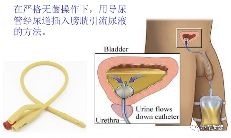 弯头导尿管怎么用留置尿管患者出现溢尿问题怎么处理_https://www.jmylbn.com_新闻资讯_第1张