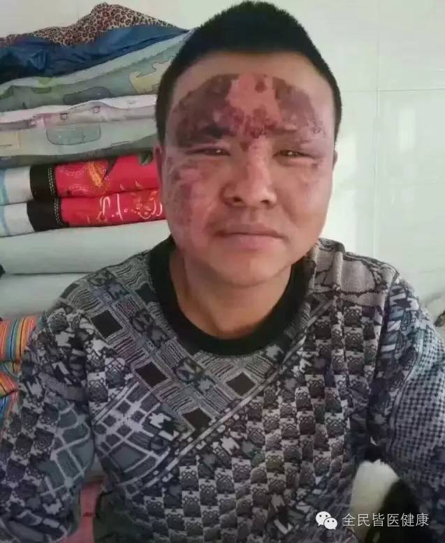 被火烧伤后你是花3万元去医院做皮肤移植手术还是用不到一千元的权健