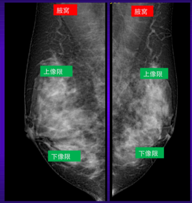 乳腺机为什么叫钼靶乳腺钼靶和乳腺彩超的区别_https://www.jmylbn.com_新闻资讯_第17张