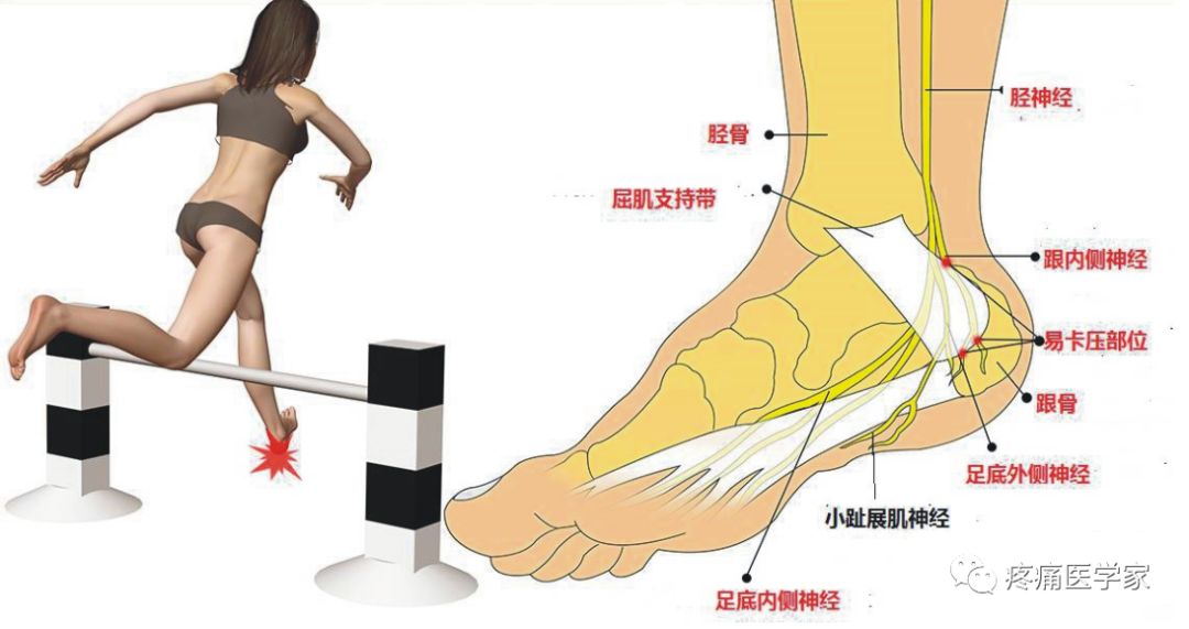 足跟疼痛解剖学分析 液针刀骨伤医学研究院 微信公众号文章阅读 Wemp