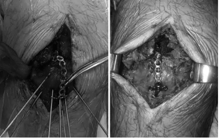 扎骨针怎么装髌骨下极粉碎骨折怎么办？7种固定技术详解与术式选择_https://www.jmylbn.com_新闻资讯_第18张