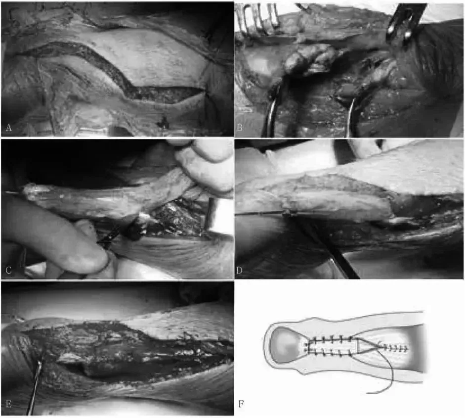 缝合器都有哪些厂家跟腱断裂常用的四种缝合修复方法，你都知道吗？_https://www.jmylbn.com_新闻资讯_第8张