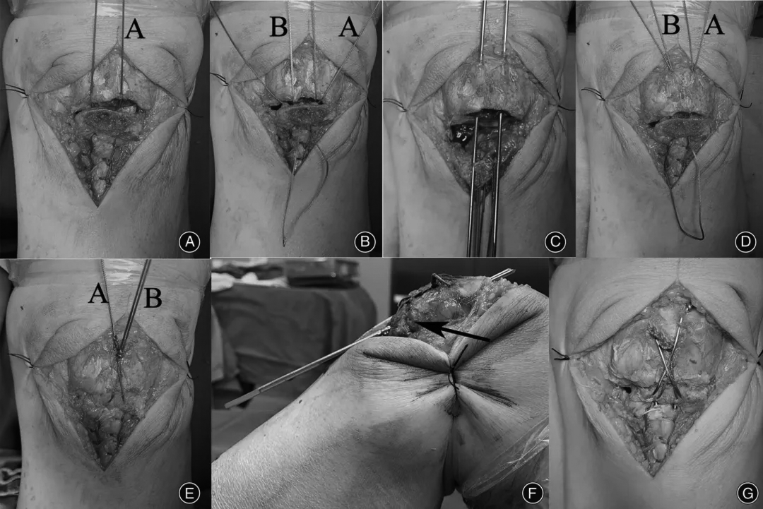 扎骨针怎么装髌骨下极粉碎骨折怎么办？7种固定技术详解与术式选择_https://www.jmylbn.com_新闻资讯_第12张
