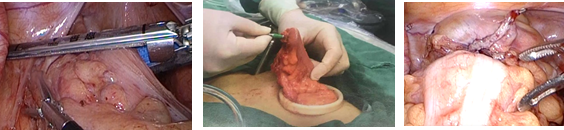 直线切割吻合器怎么用手术实践 ｜ 胃肠外科手术缝合技术（四）_https://www.jmylbn.com_新闻资讯_第4张