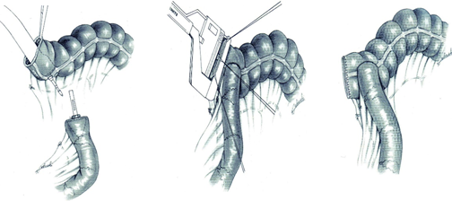 直线切割吻合器怎么用手术实践 ｜ 胃肠外科手术缝合技术（四）_https://www.jmylbn.com_新闻资讯_第3张