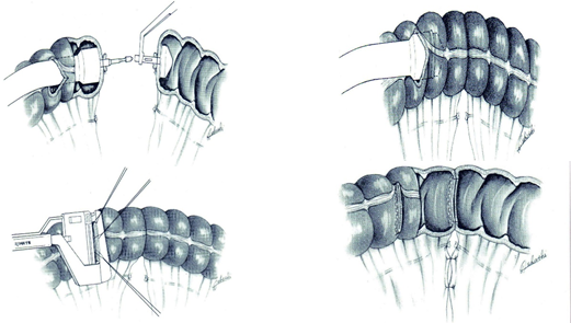 直线切割吻合器怎么用手术实践 ｜ 胃肠外科手术缝合技术（四）_https://www.jmylbn.com_新闻资讯_第2张