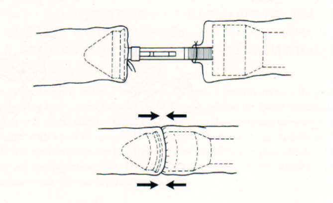 吻合器怎么用实践技巧 ｜一次性使用管型吻合器的操作方法_https://www.jmylbn.com_新闻资讯_第6张
