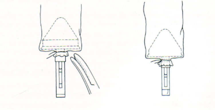 吻合器怎么用实践技巧 ｜一次性使用管型吻合器的操作方法_https://www.jmylbn.com_新闻资讯_第4张