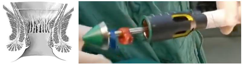 吻合器怎么用的实践技巧｜一次性使用肛肠吻合器的操作方法_https://www.jmylbn.com_新闻资讯_第11张