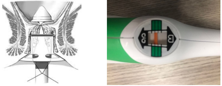 吻合器怎么用的实践技巧｜一次性使用肛肠吻合器的操作方法_https://www.jmylbn.com_新闻资讯_第8张