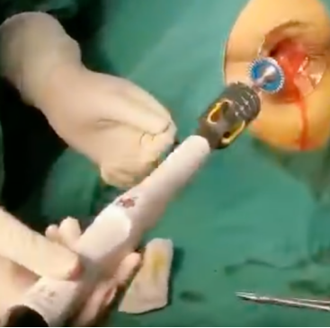 吻合器怎么用的实践技巧｜一次性使用肛肠吻合器的操作方法_https://www.jmylbn.com_新闻资讯_第6张