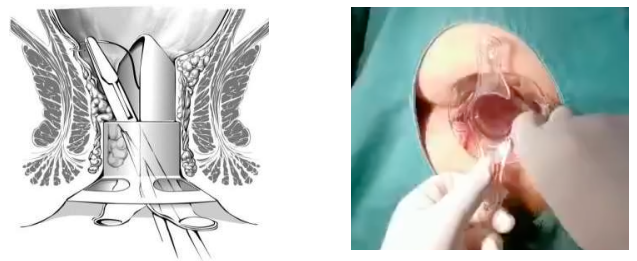 吻合器怎么用的实践技巧｜一次性使用肛肠吻合器的操作方法_https://www.jmylbn.com_新闻资讯_第5张