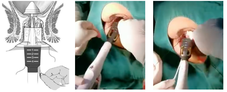 吻合器怎么用的实践技巧｜一次性使用肛肠吻合器的操作方法_https://www.jmylbn.com_新闻资讯_第7张