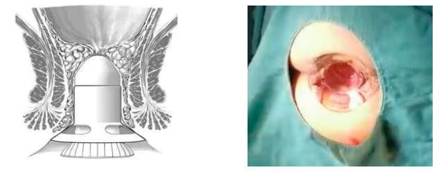 吻合器怎么用的实践技巧｜一次性使用肛肠吻合器的操作方法_https://www.jmylbn.com_新闻资讯_第4张