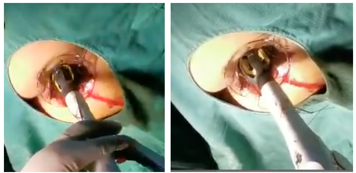 吻合器怎么用的实践技巧｜一次性使用肛肠吻合器的操作方法_https://www.jmylbn.com_新闻资讯_第10张