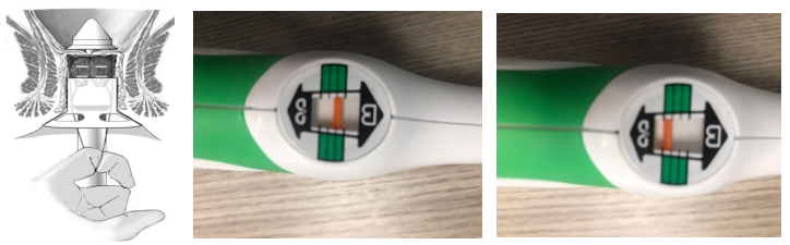 吻合器怎么用的实践技巧｜一次性使用肛肠吻合器的操作方法_https://www.jmylbn.com_新闻资讯_第9张