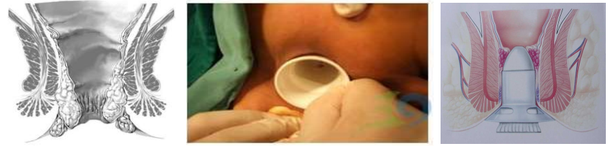 吻合器怎么用的实践技巧｜一次性使用肛肠吻合器的操作方法_https://www.jmylbn.com_新闻资讯_第3张