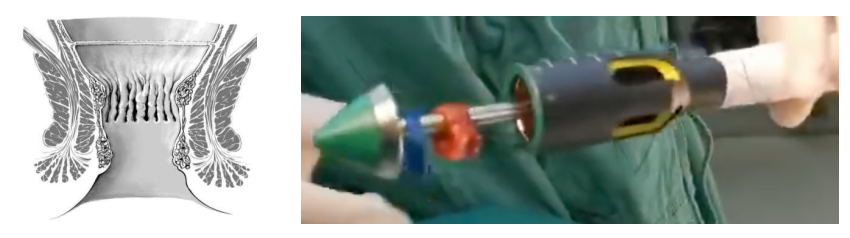 痔疮吻合器怎么使用实践技巧 ｜吻合器使用过程中常见问题及解决办法（四）_https://www.jmylbn.com_新闻资讯_第4张
