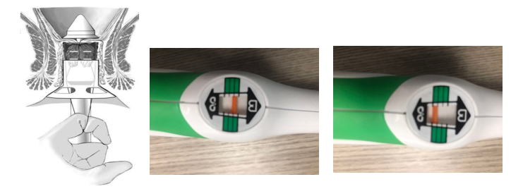 痔疮吻合器怎么使用实践技巧 ｜吻合器使用过程中常见问题及解决办法（四）_https://www.jmylbn.com_新闻资讯_第2张